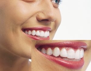 Invisalign_Trio3
