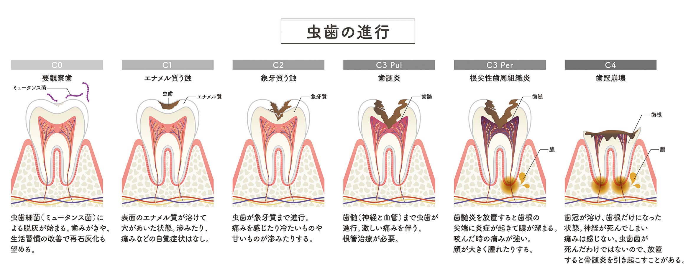 虫歯の進行度とおもな治療法