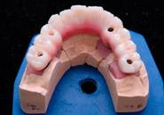 implant_case2_05