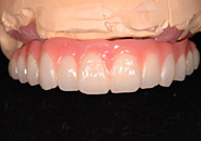 implant_case2_07