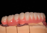 implant_case2_08