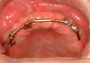 implant_case3_03