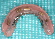 implant_case3_04