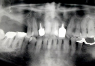 implant_case4_01