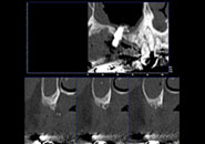 implant_case4_02