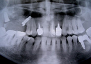 implant_case4_05