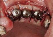 implant_case5_07