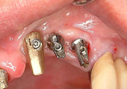 implant_case5_08