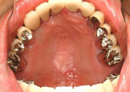 implant_case5_09