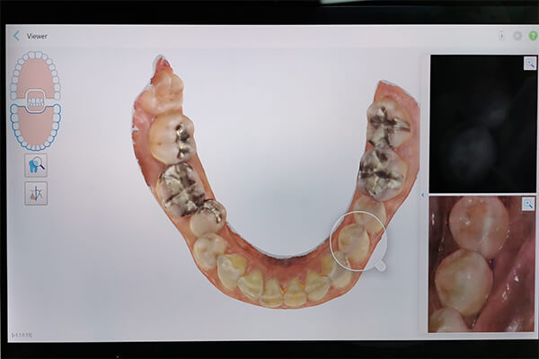 歯の状態を細かくチェックすることができます