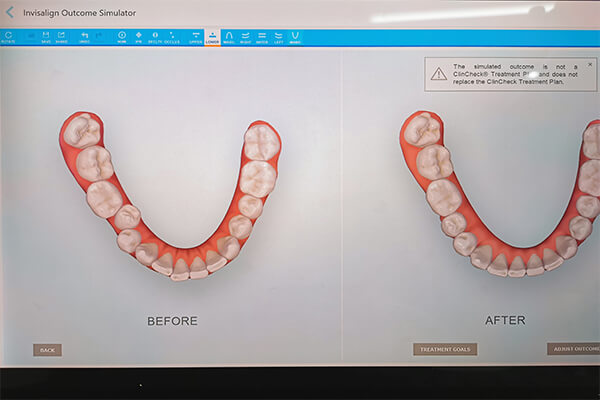 矯正も付属ソフトのAIを使ってシュミレーションすることができるので、矯正治療の結果がイメージしやすくなります。