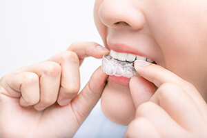 Invisalign_Trio1