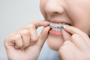 Invisalign_Trio2