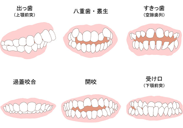 噛み合わせ 矯正治療